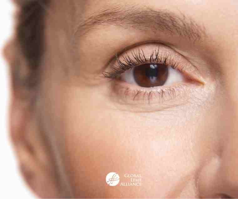 Lyme Disease and the Eyes